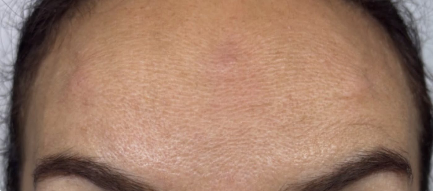 The same client's forehead after anti-wrinkle treatment at AbbieJaine Aesthetics, Basildon