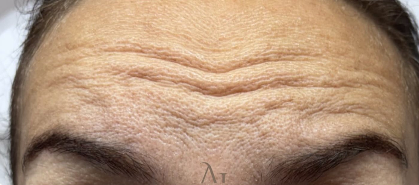 A client's forehead lines before anti-wrinkle treatment at AbbieJaine Aesthetics, Basildon