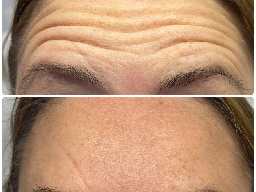 Anti-wrinkle forehead result, before and after, AbbieJaine Aesthetics Basildon