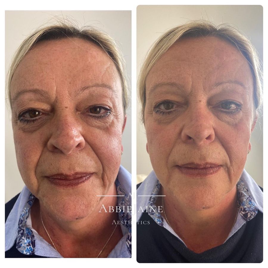 Soft, subtle results using 2ml of dermal filler