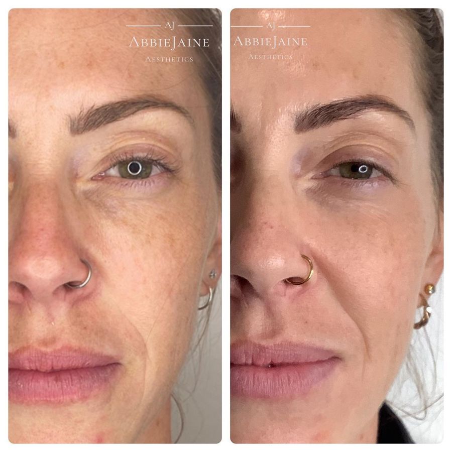 Hyperpigmentation