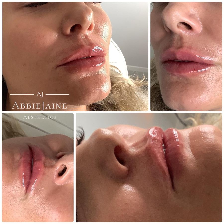 Lip filler dissolved, then carefully redone