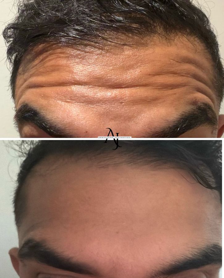 Anti-wrinkle, for men too