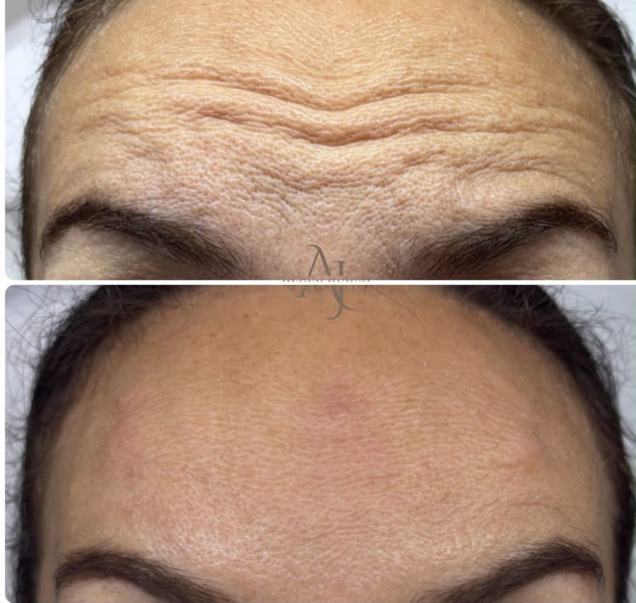 Anti-wrinkle, forehead