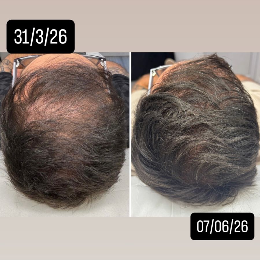 Hair restoration, nine weeks apart
