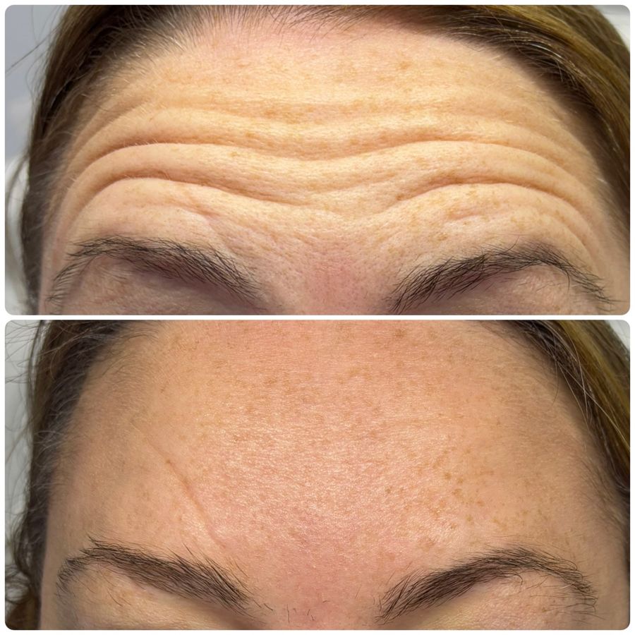 Anti-wrinkle, forehead