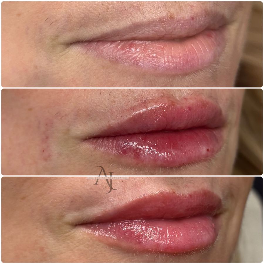 Lip filler 0.6ml: before, straight after, healed