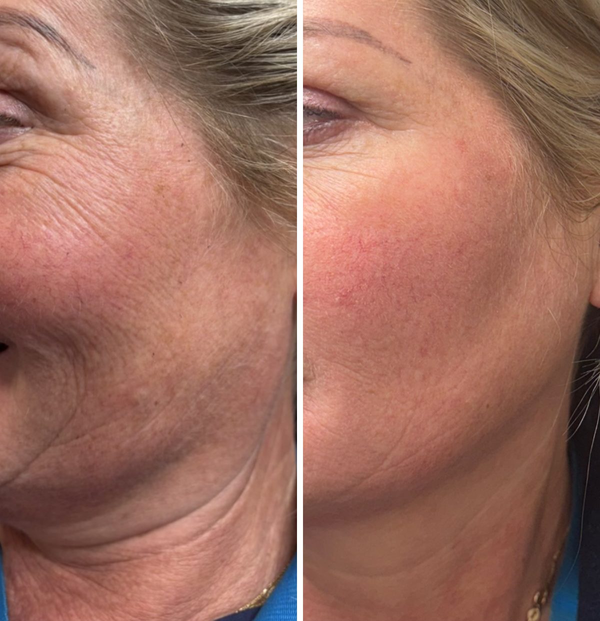 Skin boosters and Cellular Matrix, before and after