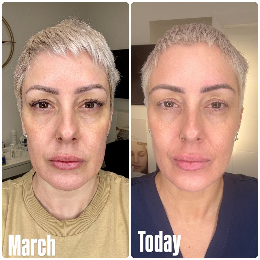 My own skin, from March to December