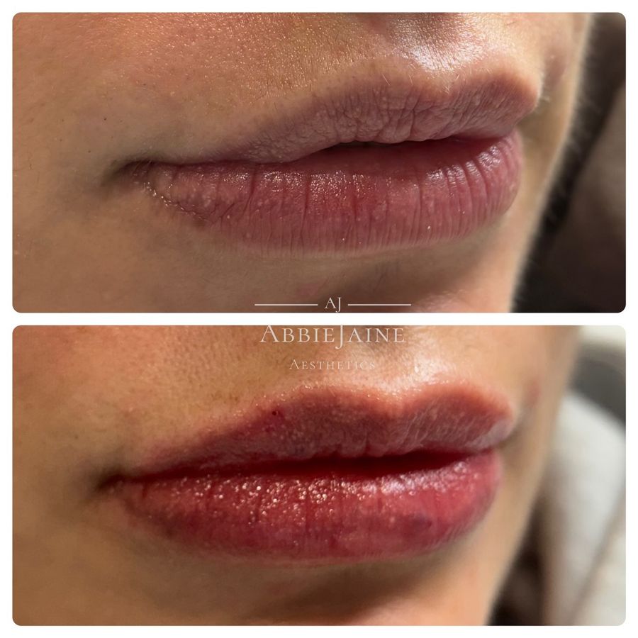 Lip filler, Restylane Kysse 0.6ml