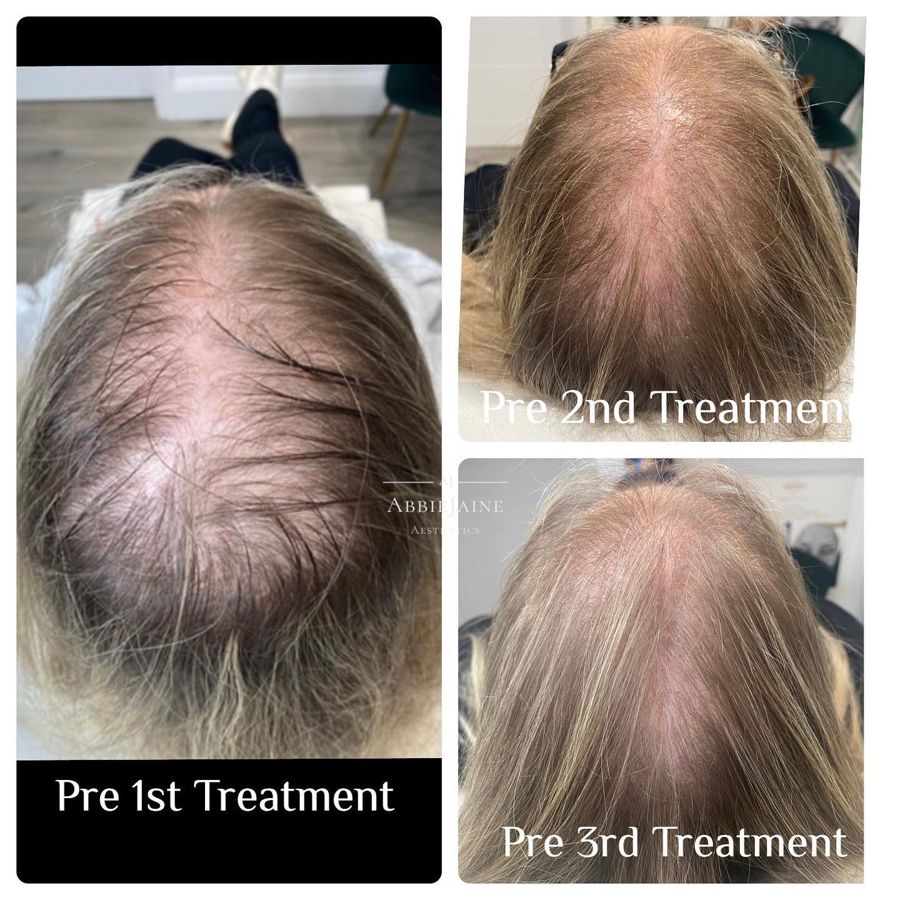 PRP for thinning hair